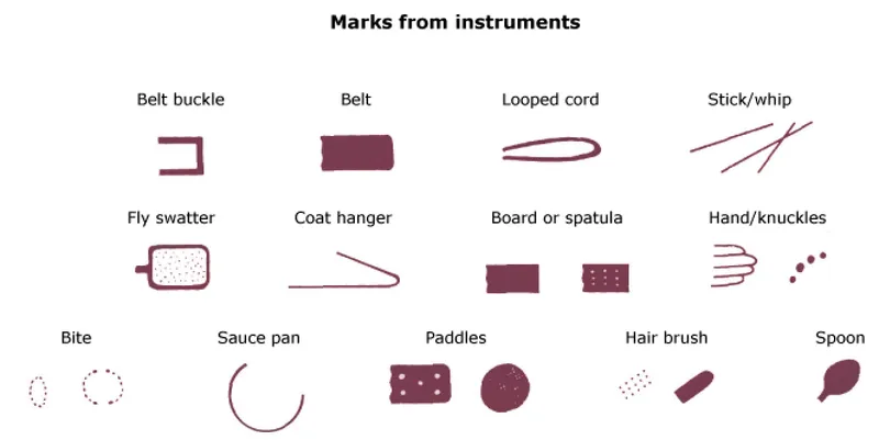 Figure 2: Clinical photograph showing finger-tip bruising pattern on upper arm consistent with gripping injury
