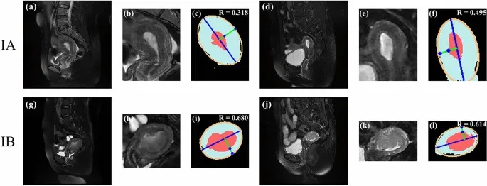 MRI images showing different stages of myometrial invasion in endometrial cancer