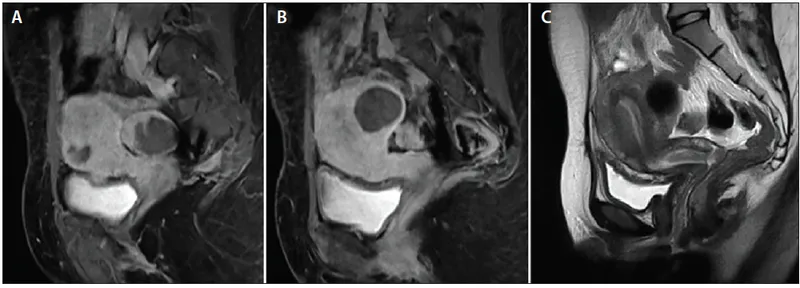 MRI images comparing normal uterus, fibroids, and adenomyosis appearances