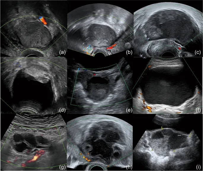 Ultrasound comparison showing normal ovary versus various pathological conditions
