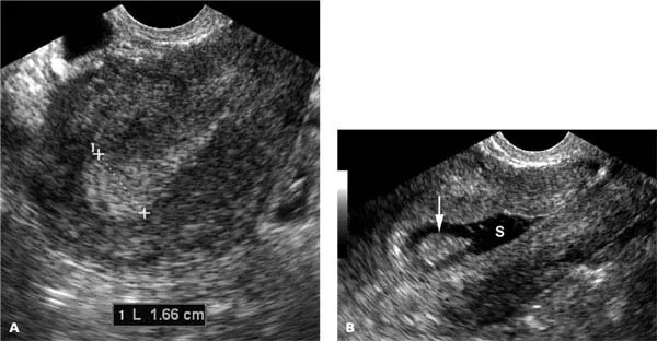 Ultrasound image showing thickened endometrium measurement