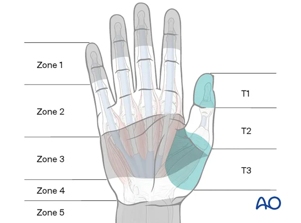 Detailed view of flexor tendon zones in the hand
