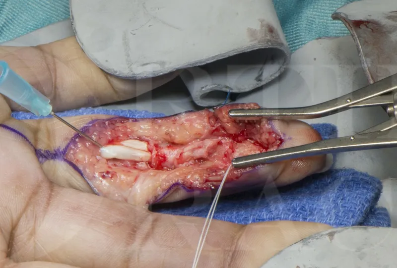 Surgical technique demonstration of tendon repair
