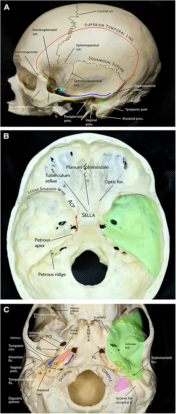 Middle cranial fossa showing sella turcica and cavernous sinus anatomy