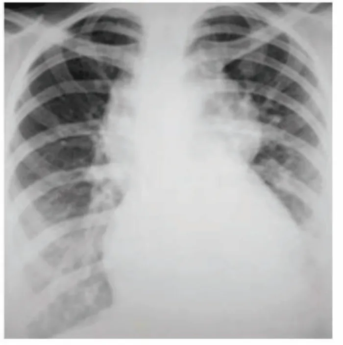 Figure 2: Chest X-ray showing cardiomegaly with bilateral pleural effusions