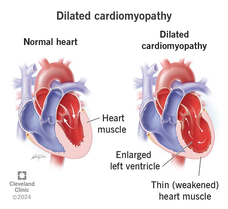 Figure 1: Echocardiogram showing dilated left ventricle with reduced wall motion
