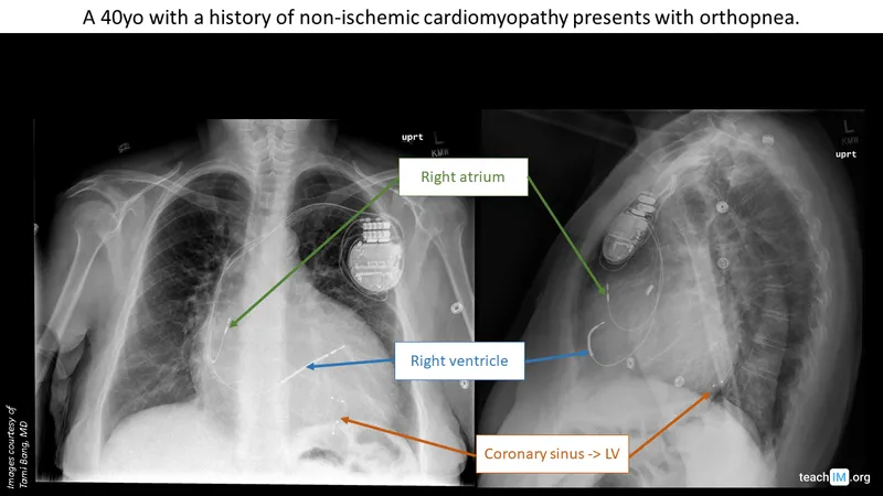 X-ray image showing implanted CRT-D device with leads in heart chambers