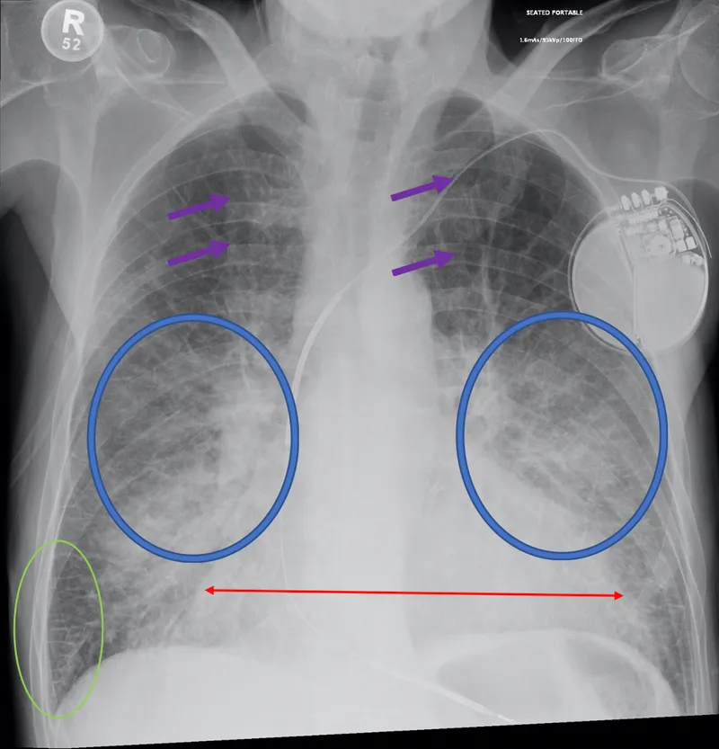 Chest X-ray showing pulmonary vascular congestion and cardiomegaly