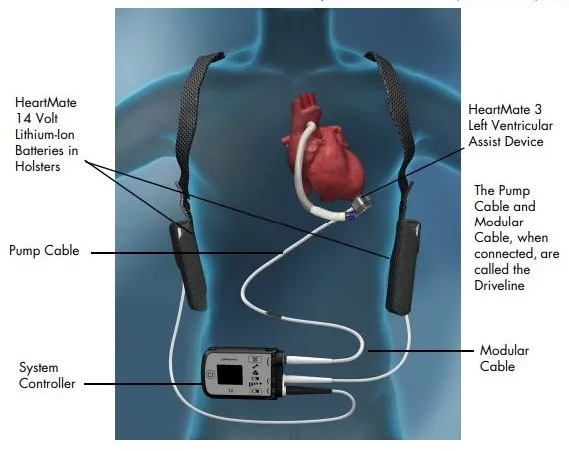 Diagram showing LVAD placement and blood flow through artificial pump