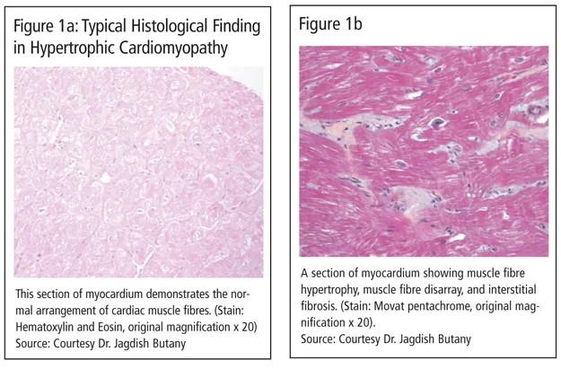 Microscopic image showing myocardial fibrosis and hypertrophy in heart failure
