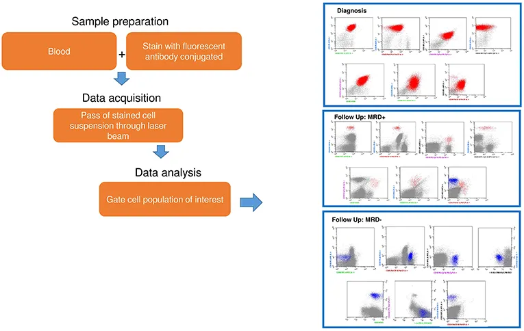 Flow cytometry plot showing minimal residual disease detection in acute leukemia