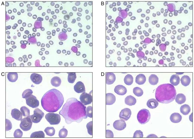 Peripheral blood smear showing circulating blasts with high nuclear-cytoplasmic ratio
