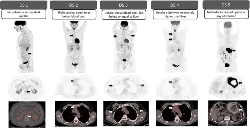 PET scan showing complete metabolic response in lymphoma after treatment