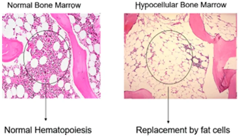 normal bone marrow aspirate