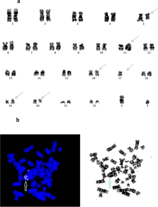 Karyotype showing complex chromosomal abnormalities in high-risk AML