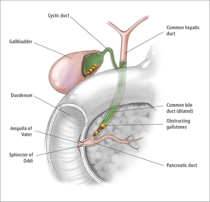 cholesterol gallstone formation