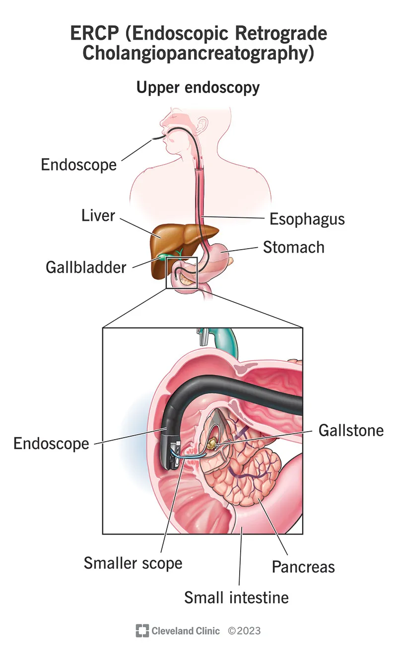ERCP cannulation technique