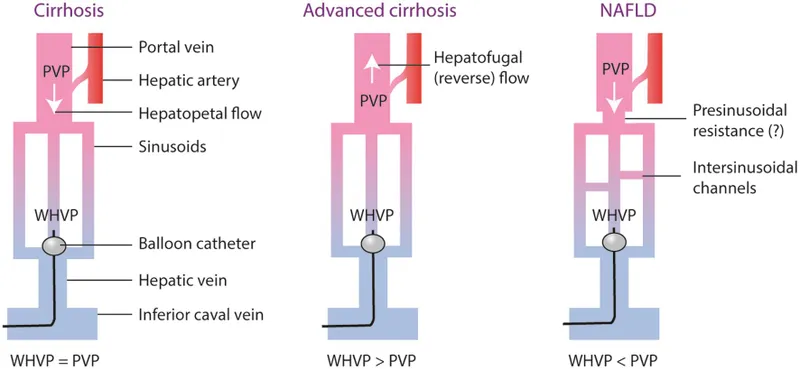 portal hypertension pathophysiology