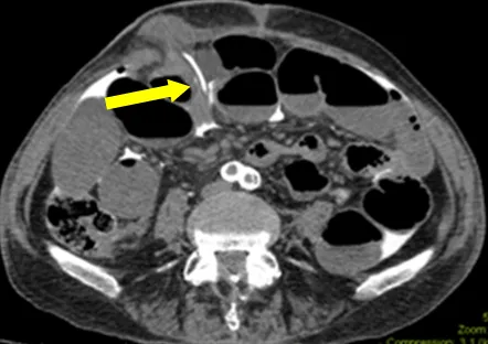 Figure 1: CT scan showing bowel wall thickening and fat stranding in incarcerated inguinal hernia