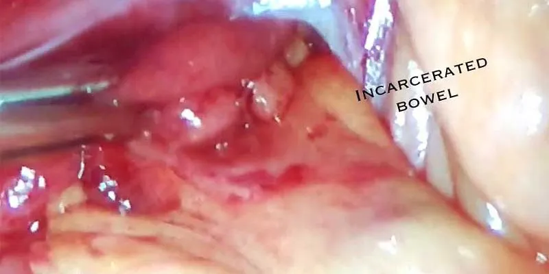 Figure 2: Clinical photograph showing irreducible right inguinal hernia with overlying erythema