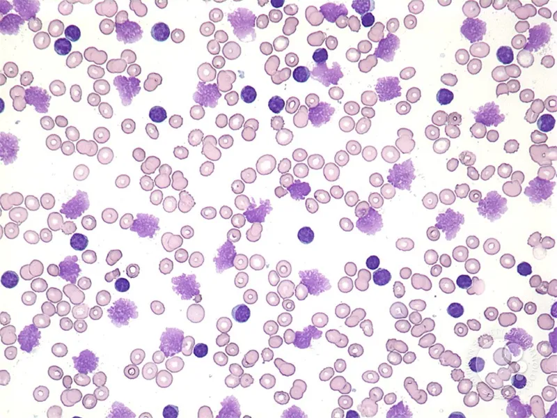Figure 2: Blood film showing thrombocytopenia with reduced platelet count