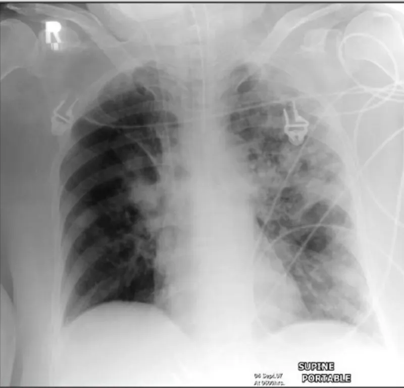 Chest X-ray showing ventilator-associated pneumonia with bilateral infiltrates