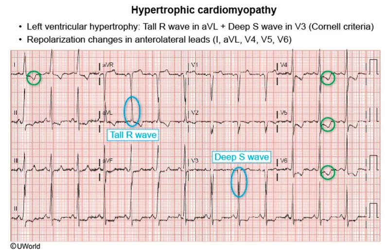 Figure 2: ECG showing left ventricular hypertrophy with strain pattern