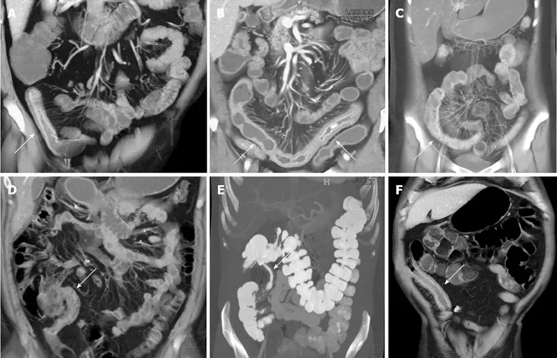 CT scan showing Crohn's disease complications including strictures and fistulas