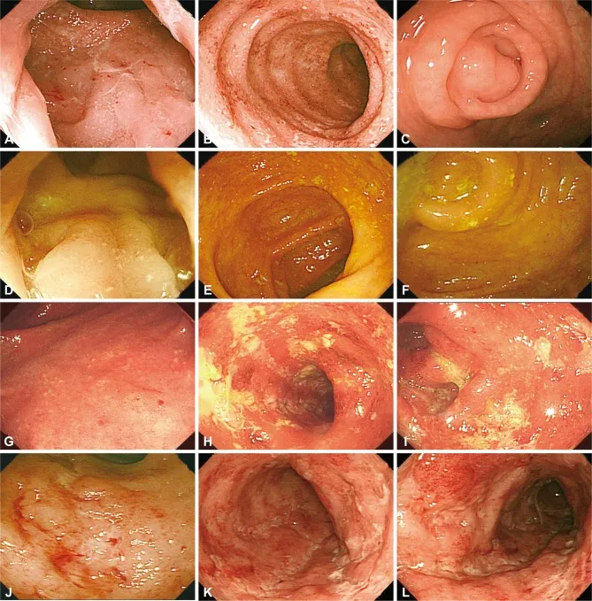 Endoscopic comparison showing normal colon mucosa versus IBD inflammation