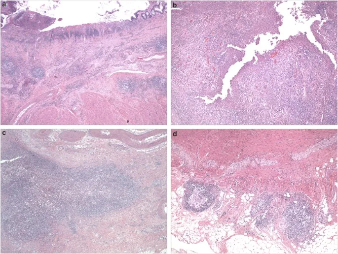Histological comparison showing UC versus CD inflammatory patterns and granulomas