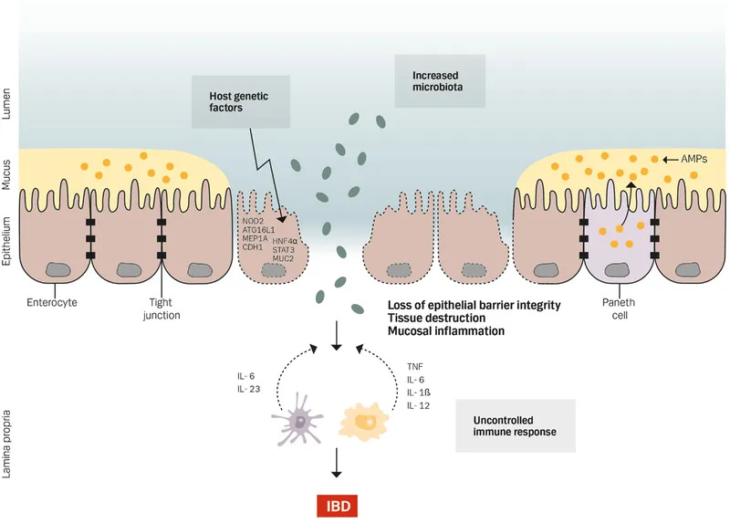 Detailed diagram of IBD pathogenesis showing immune cell interactions and inflammatory mediators