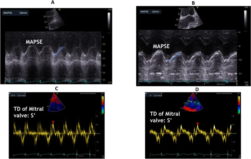 Echocardiogram showing septic cardiomyopathy with reduced ejection fraction