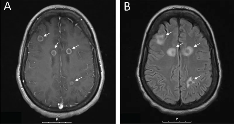 cerebral malaria mri