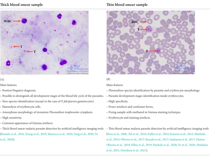 malaria blood smear