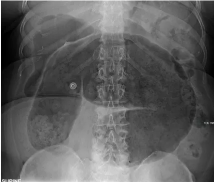 Figure 2: Abdominal X-ray showing dilated transverse colon greater than 6cm in toxic megacolon