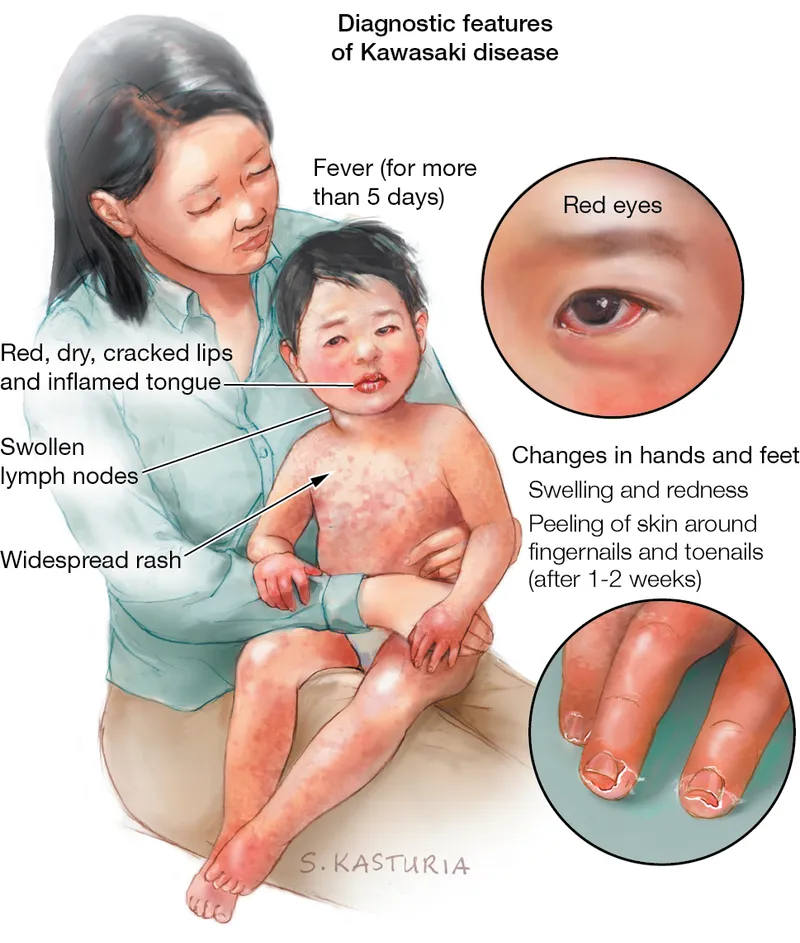 Hand and foot changes in Kawasaki disease showing erythema and desquamation
