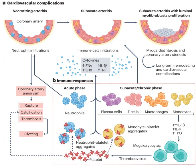 Pathophysiology diagram showing inflammatory cascade in Kawasaki disease vasculitis