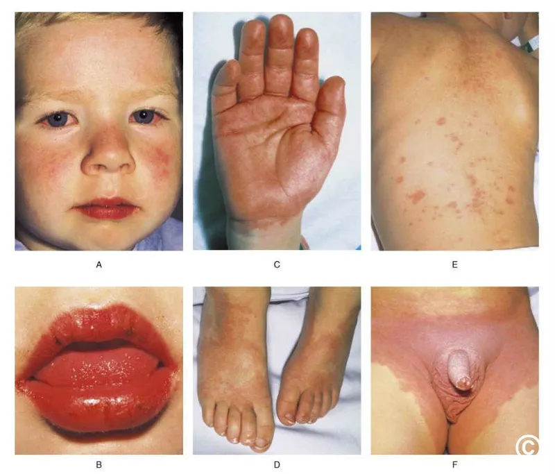 Strawberry tongue and lip changes characteristic of Kawasaki disease