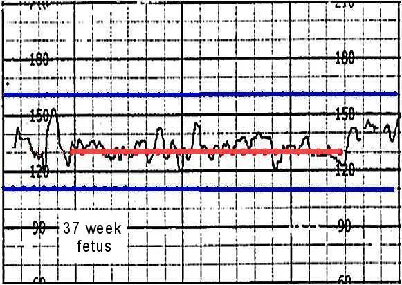 Fetal heart rate monitoring showing normal and abnormal patterns