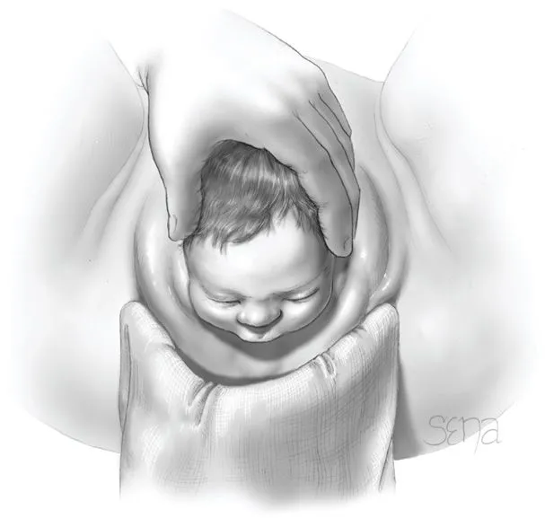 Second stage of labor showing fetal crowning and delivery