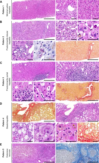 Liver biopsy histology showing fibrosis staging and inflammatory changes