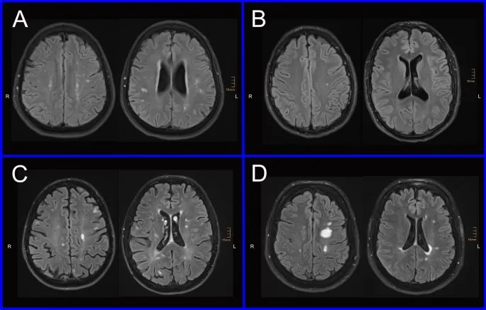 MRI brain changes in different lysosomal storage diseases comparison