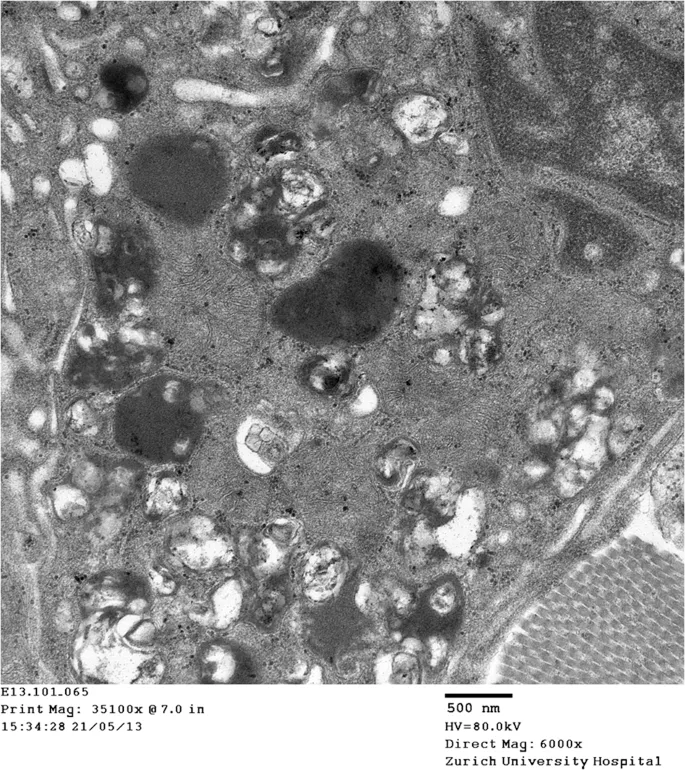 Electron microscopy showing normal lysosome versus enlarged storage-filled lysosome