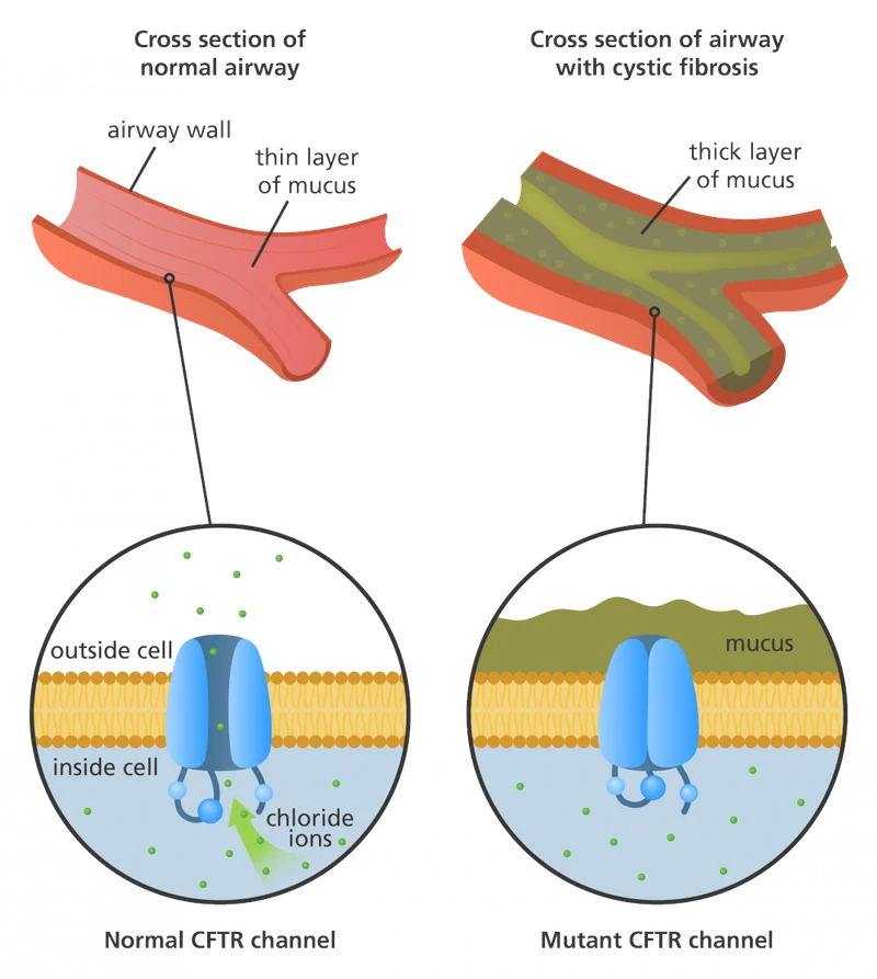 Diagram showing CFTR protein structure and cystic fibrosis mutations