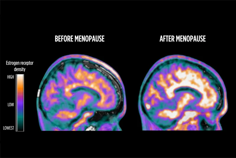 Brain regions affected by menopause showing cognitive and mood centers