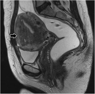 MRI pelvis showing adenomyosis with junctional zone thickening and T2 hyperintensity