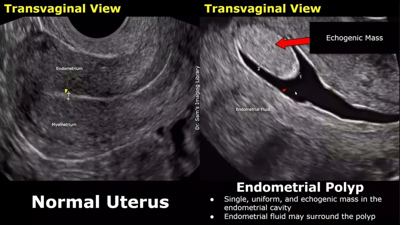 Ultrasound images comparing normal endometrium fibroids polyps and adenomyosis