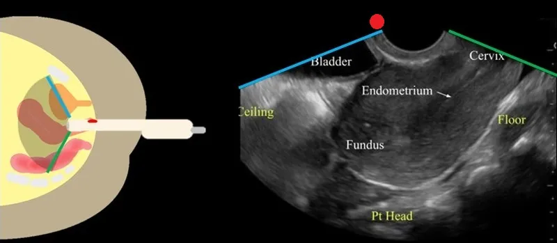 Transvaginal ultrasound technique showing optimal probe positioning for endometrial assessment