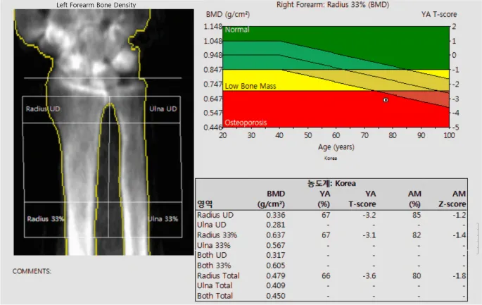 Bone densitometry showing preferential cortical bone loss in hyperparathyroidism