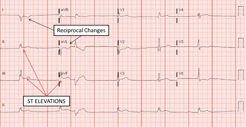 12-lead ECG showing classic STEMI pattern with ST elevation and reciprocal changes